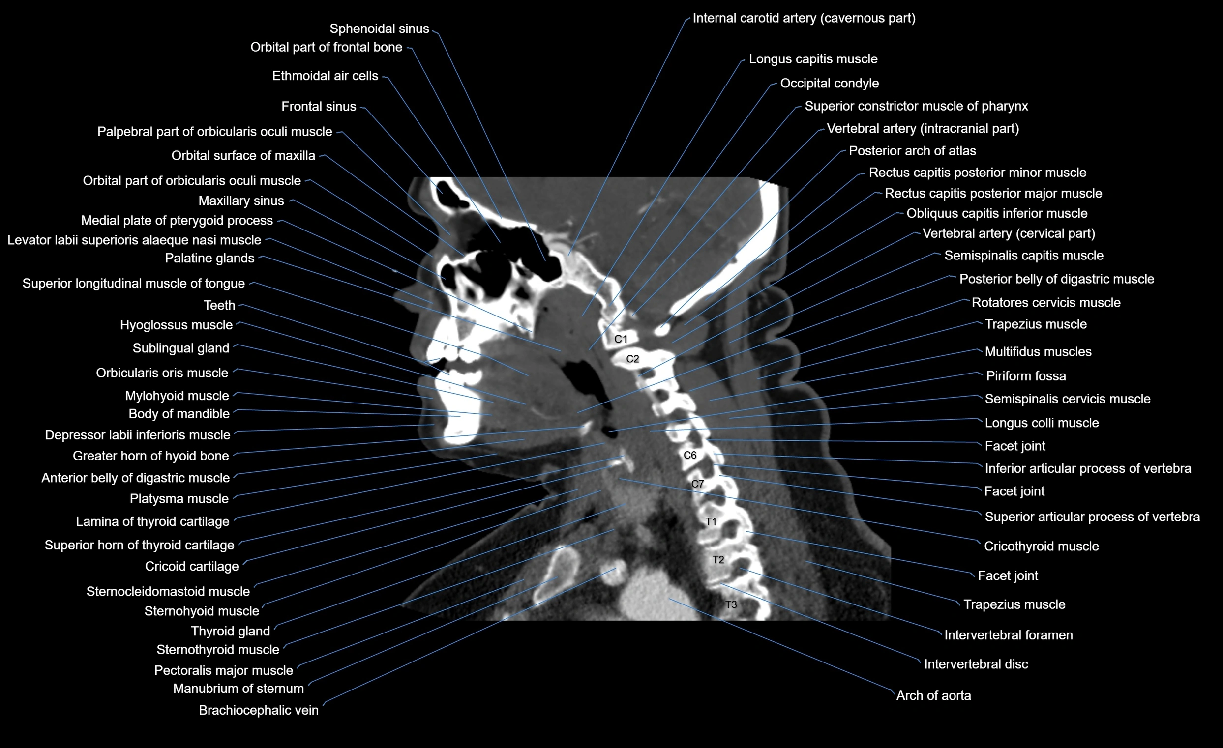 Neck CT sagittal cross sectional anatomy 3D  radiology  image-img-00001-00006.webp